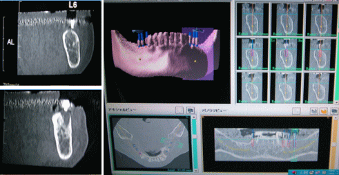 インプラント埋入のシミュレーション